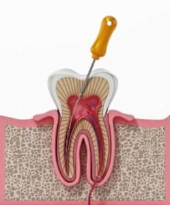 Root Canal Treatment in Ashram