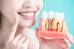 Dental Implants in Ashram