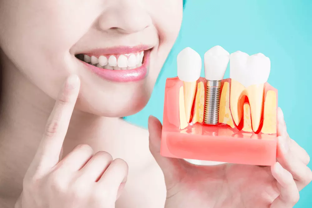 Dental Implants in Ashram