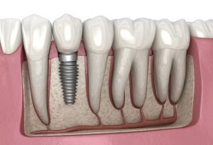 Dental Implants In Maharani Bagh