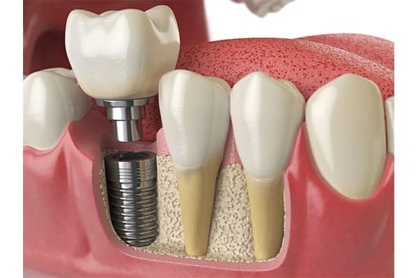 Prosthodontic Treatment in Ashram