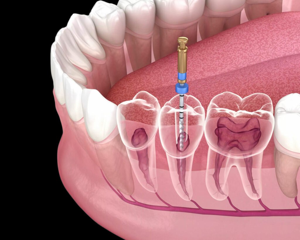 Root Canal Treatment in Maharani Bagh