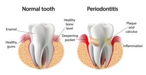 Periodontics Treatment in Ashram