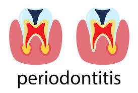 Periodontics Treatment in Maharani Bagh