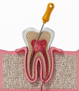 Root Canal Treatment in Sunlight Colony