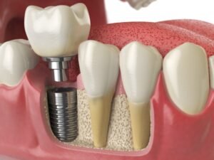 Best Dental Implants in Sunlight Colony