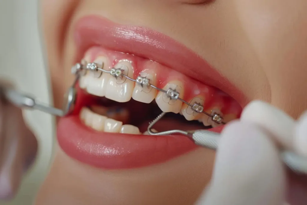 Best Metal Braces Clinic in South Delhi