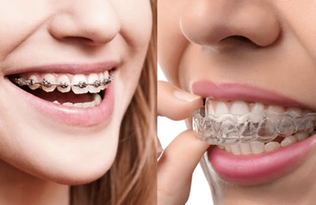 Best Braces and Aligners in Sunlight Colony