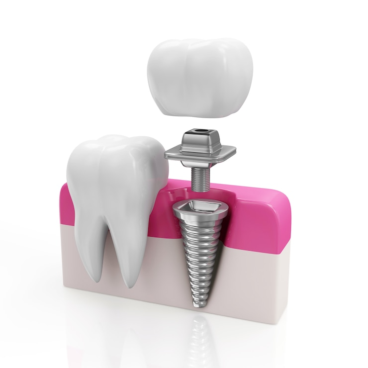 Best Dental implants clinic in Bhagwan Nagar